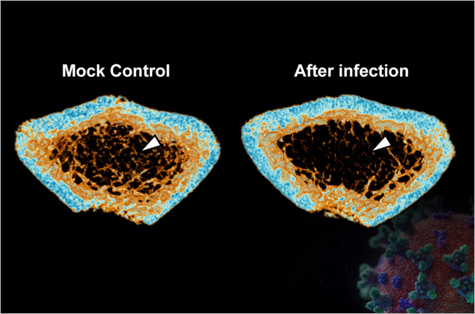 SARS-CoV-2 infection induces severe inflammatory bone loss in Syrian hamsters