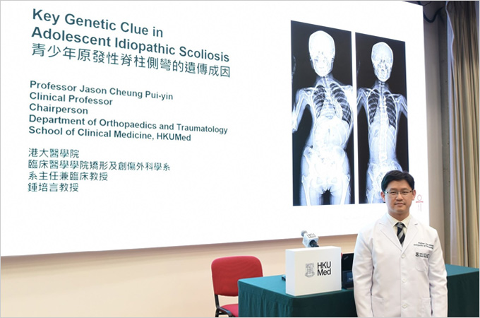 HKUMed researchers uncover key genetic clue in adolescent idiopathic scoliosis